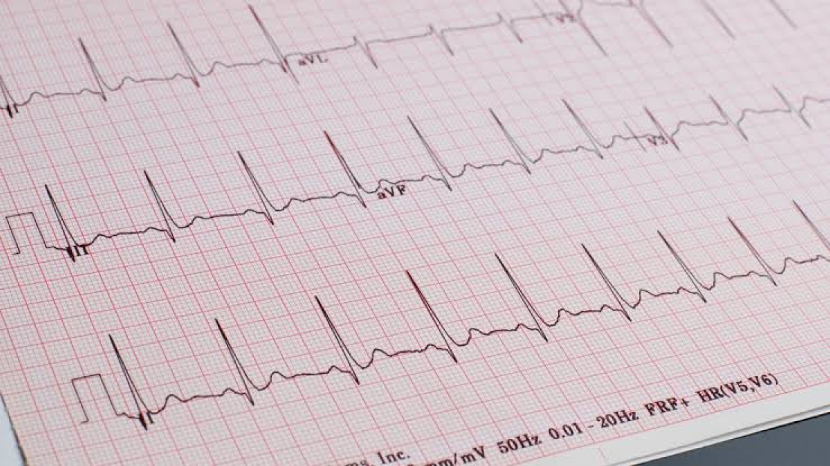 ECG